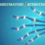 Understanding Rheumatoid Arthritiss: A Comprehensive Guide