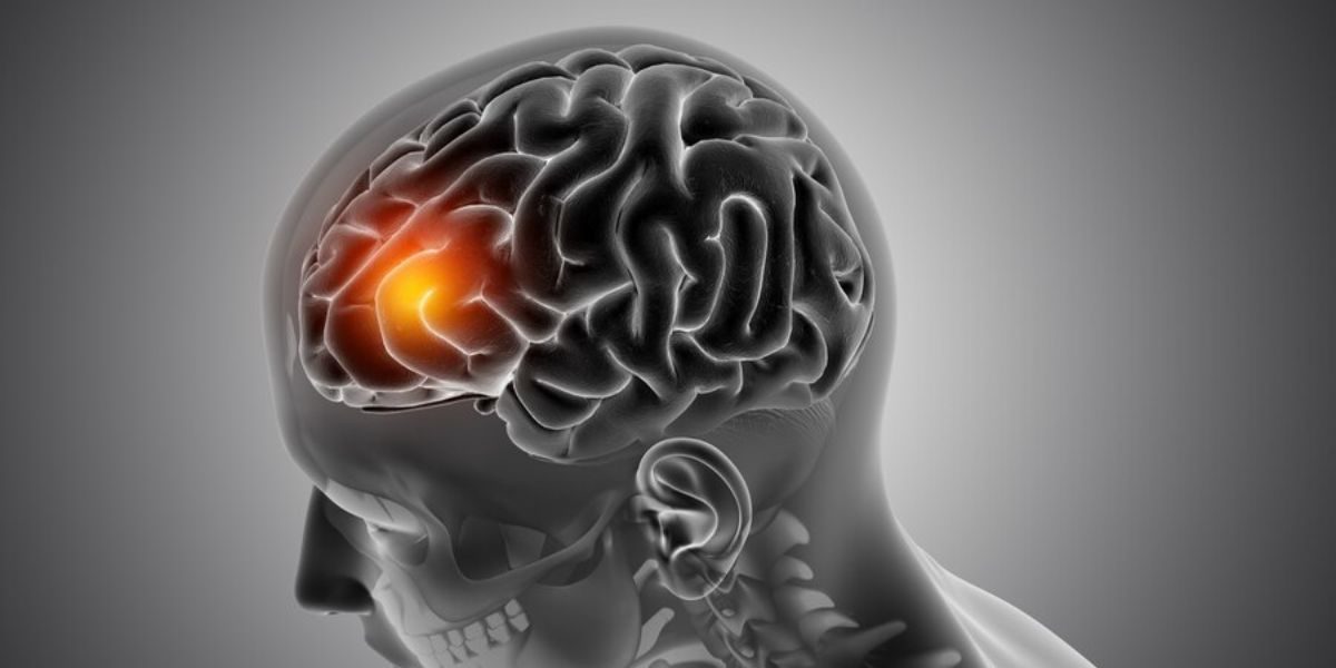 Brain inflammation, or encephalitis, manifests through a wide range of symptoms that can vary in severity.