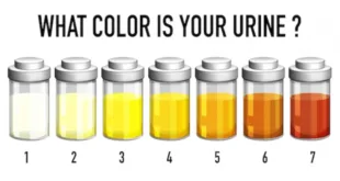 Urine Analysis Test Kits: 6 Powerful Benefits You Need Today