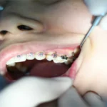 Sydney Dental Implants: Restore Your Smile with Confidence