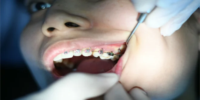 Sydney Dental Implants: Restore Your Smile with Confidence
